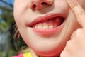 Close up  swelling on gums child Royalty Free Stock Photo