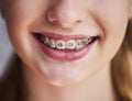 Close up of teeth with braces Royalty Free Stock Photo