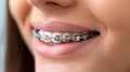 Close up of teeth with braces, orthodontic treatment concept in dental clinic environment Royalty Free Stock Photo