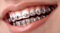 Close up of teeth with braces, orthodontic treatment concept, dental healthcare background Royalty Free Stock Photo