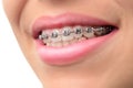 Close-up teeth with braces Royalty Free Stock Photo