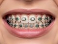 Close-up of teeth with green braces Royalty Free Stock Photo