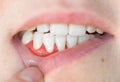 close-up of teeth. gum disease in a woman, periodontal disease. tartar removal, dental treatment Royalty Free Stock Photo