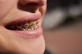 Close up to a young caucasian lady's mouth wearing braces or brackets. Her orthodontic treatment is ceramic braces. Royalty Free Stock Photo