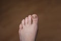 Close-up of the toes of a woman with ingrown toenails with a fungal infection. The concept of nail care and treatment of Royalty Free Stock Photo