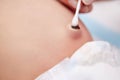 Treatment of newborn baby navel with cotton swab