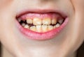 Close up of unhealthy baby teeths. Open mouth of a little boy with improperly growing teeth close-up. The concept of