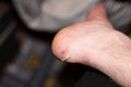 Close up of an unknowns person heel with a blister