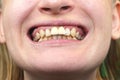 Close-up of unsuccessfully implanted dental implants Royalty Free Stock Photo