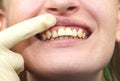 Close-up of unsuccessfully implanted dental implants