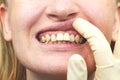 Close-up of unsuccessfully implanted dental implants