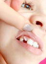 The child shows a problematic uneven tooth. Treatment, bite correction, braces. Royalty Free Stock Photo
