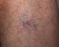 close up of varicose veins on the leg of an elderly caucasian woman Royalty Free Stock Photo