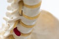 Close-up view of herniated lumbar disc model Royalty Free Stock Photo