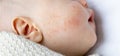 red pimples allergic skin atopic on baby infant face