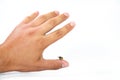 Close up view of bee sting mans finger on white background. Wasp on human finger, most people have allergic reaction