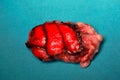 Specimen of epileptic brain from surgery Royalty Free Stock Photo