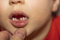 Close up view of child`s mouth with first lost tooth. Royalty Free Stock Photo