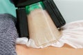 Close-up view of cryolipolysis treatment. Hardware cosmetology, noninvasive technology Royalty Free Stock Photo