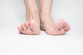 Close-up female sore skin of feet, dry heels isolated on a white background