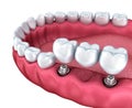 A close-up view of lower teeth and dental implants