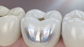 Modern dental crown restoration on a tooth showing internal structure and reflective surface Royalty Free Stock Photo