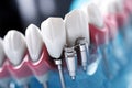 Close-up view of modern dental implants Royalty Free Stock Photo