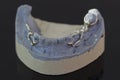 Close up view of plaster model of lower teeth with metal prosthesis