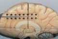 Subdural electrode on medial side of brain hemisphere