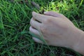 Close-up view, top view of Asian woman& x27;s hand scar, skin with old scars