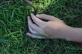 Close-up view, top view of Asian woman& x27;s hand scar, skin with old scars