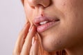 Beautiful woman with herpes. Herpes on the lips of a young woman Royalty Free Stock Photo