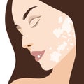 Close up vitiligo skin problems on woman\'s face illustration on white background