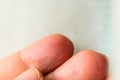 Close up wet callus or blister on the hand finger, healthcare and medical concept