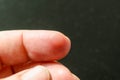 Close up wet callus or blister on the hand finger, healthcare and medical concept