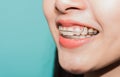 Close up white teeth of young Asian beautiful woman smiling wear silicone orthodontic retainers Royalty Free Stock Photo