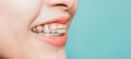 Close up white teeth of young Asian beautiful woman smiling wear silicone orthodontic retainers Royalty Free Stock Photo