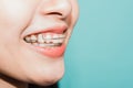 Close up white teeth of young Asian beautiful woman smiling wear silicone orthodontic retainers Royalty Free Stock Photo