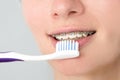 Close-up of woman with braces brushing her teeth. Orthodontics and dental care. Photo Royalty Free Stock Photo