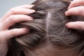 Close up of woman examining her scalp and hair, hair loss on hairline or dry scalp problem.