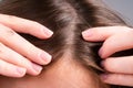 Close up of woman examining her scalp and hair, hair loss on hairline or dry scalp problem.