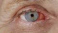 Close up. woman eye with burst capillaries, cataract surgery