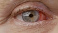 Close up. woman eye with chemical burns of the cornea. burst capillaries, cataract surgery