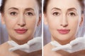 Close up woman face before after lifting injection. Middle age lady before-after wrinkled skin, eye bags, nasolabial folds. Face Royalty Free Stock Photo