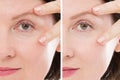 Close up woman face before after lifting injection. Middle age lady before-after wrinkled skin, eye bags, nasolabial folds. Face