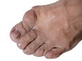 Close-up of woman foot feet with bunion on hallux