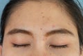 Close up of woman head, closed her eyes with the problem of Acne and Scar from acne inflammation Papule and Pustule on her foreh