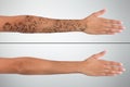 Woman`s Hand Before And After Laser Tattoo Removal Royalty Free Stock Photo