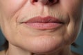 Close up of woman\'s nasolabial folds and wrinkles around mouth