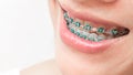 Close up woman smiling with Ceramic and Metal Braces Royalty Free Stock Photo